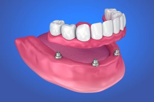 All-On-4 Dental Implant Cost