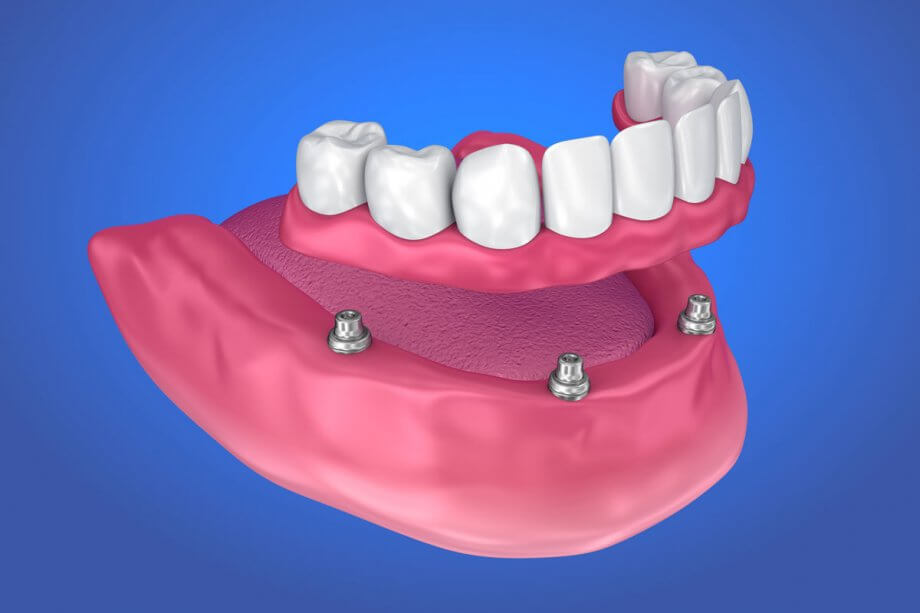 All-On-4 Dental Implant Cost