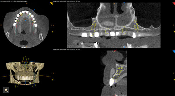 Implant Dentistry Surgery Framingham, MA