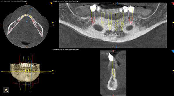 Implant Dentistry Surgery Newton, MA