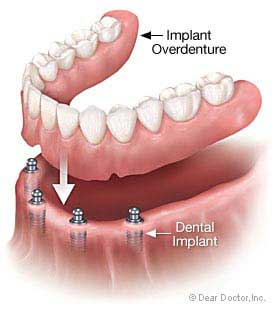 Dental Implants in Murrieta, CA