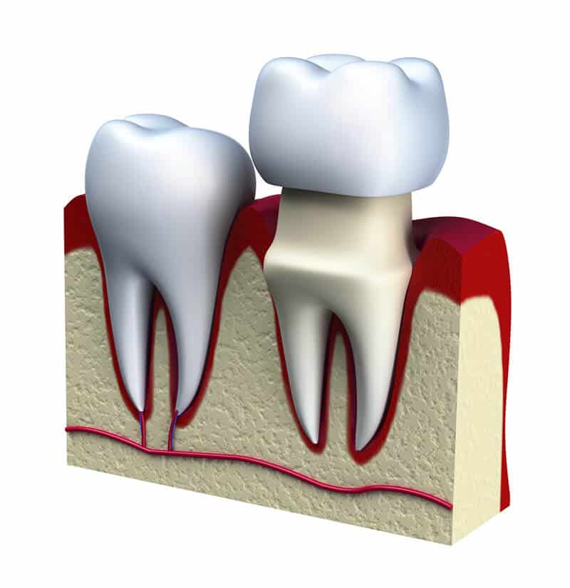 Dental implant and crown s (1)
