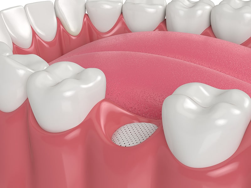 3 Types of Bone Grafts Used in Periodontal Surgery in Framingham