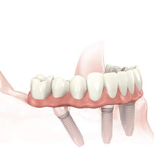 Full Mouth Dental Restorations in Newton