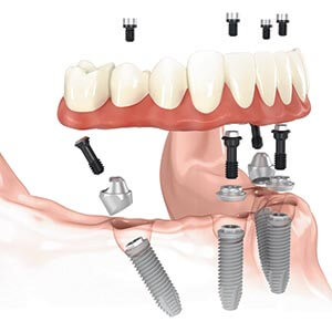 Dental Implant Supported Restorations in Newton