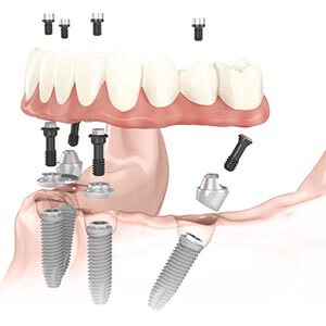 Dental Implant Supported Restorations in Framingham