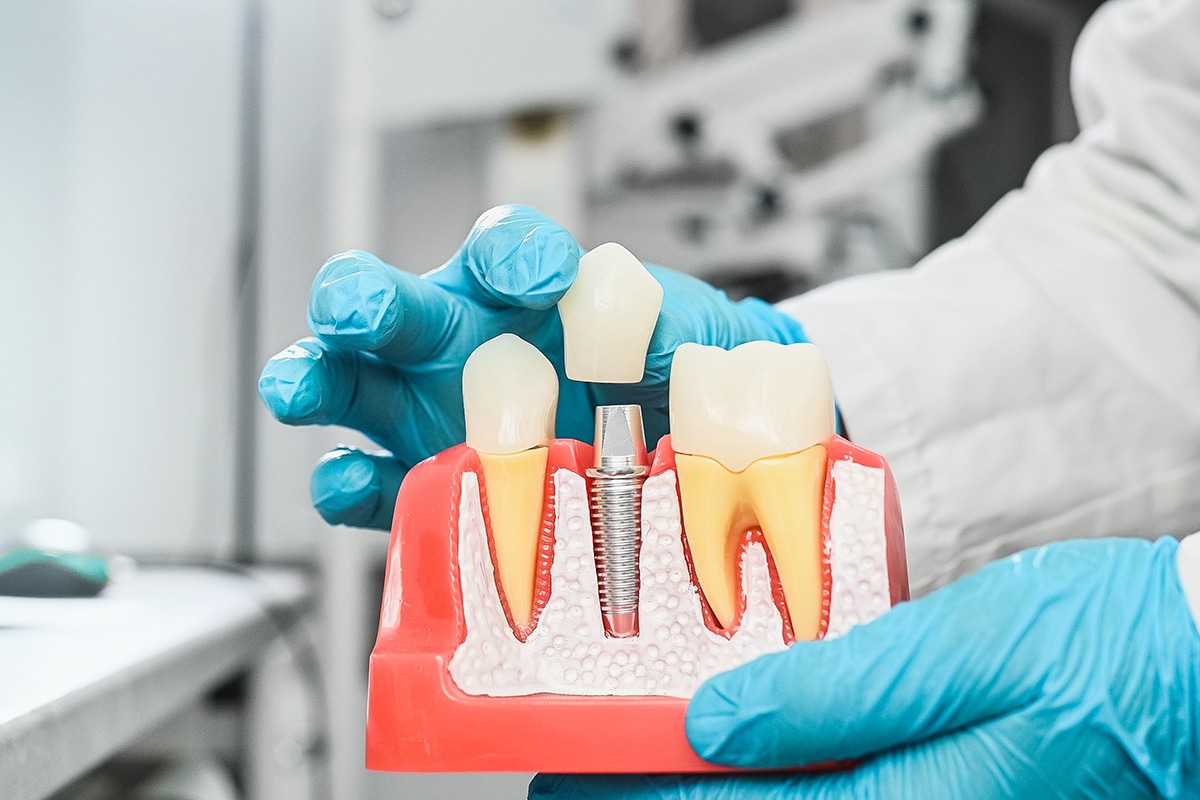 Are dental implants a permanent solution for tooth loss blog