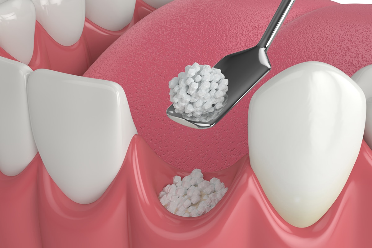 Bone grafting for dental implants what to expect before surgery blog