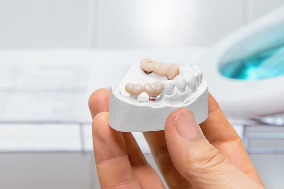 Can A Dental Bridge Be Removed And Recemented?