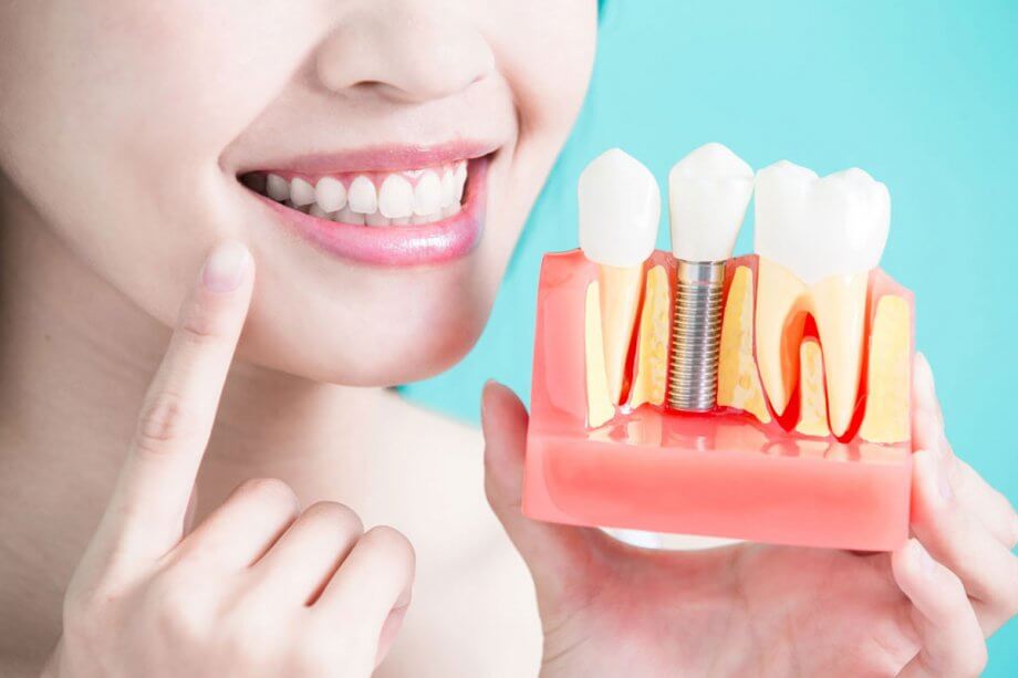 dental implants