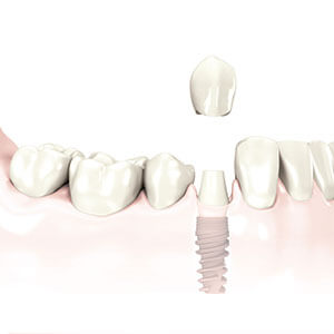 Single Dental Implants in Newton & Framingham