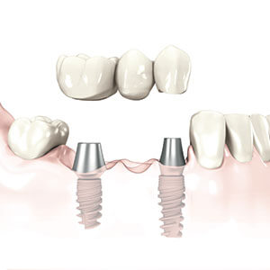 Dental Implants