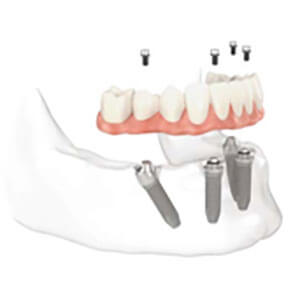 Full Mouth Restorations in Newton & Framingham