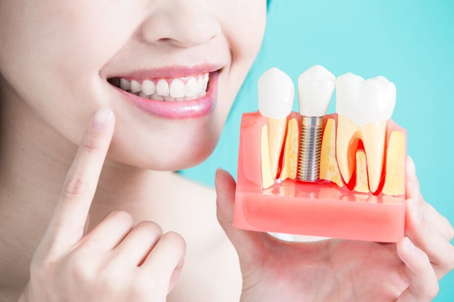How do you clean dental implants 920x613