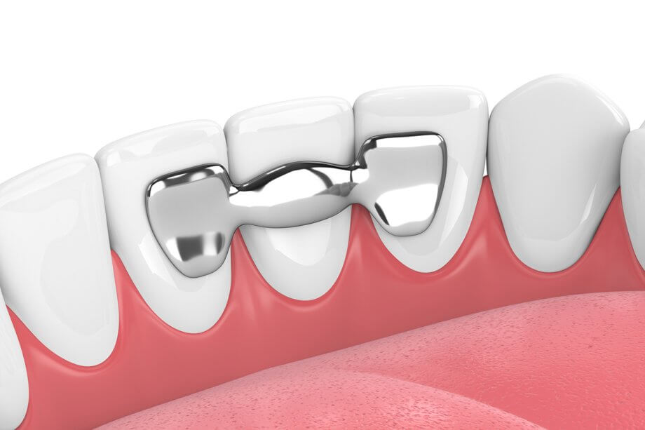 What are the benefits and types of undergoing temporary tooth bridges?