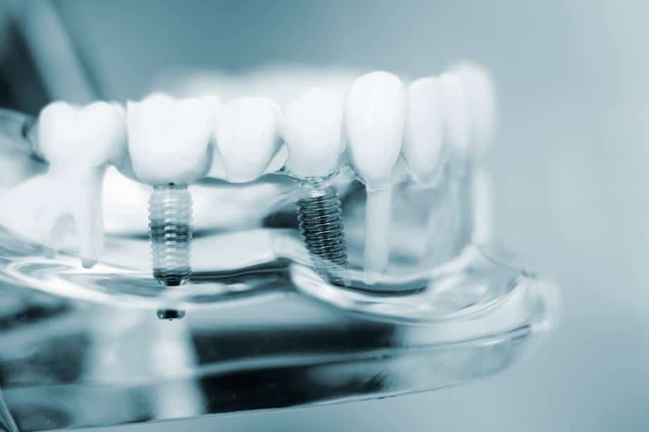 How much do dental implants cost in middlesex county ma 920x613