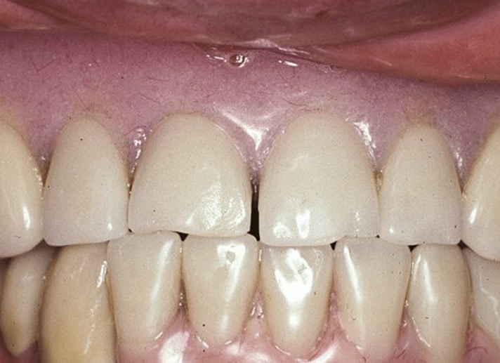 Hy dental implants fixed