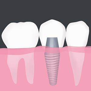 Dental Implants in Newton & Framingham