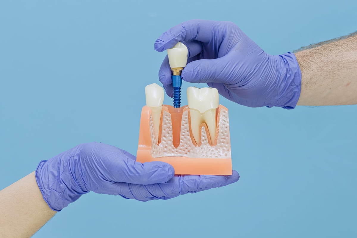 One day teeth vs traditional implants which saves more time blog